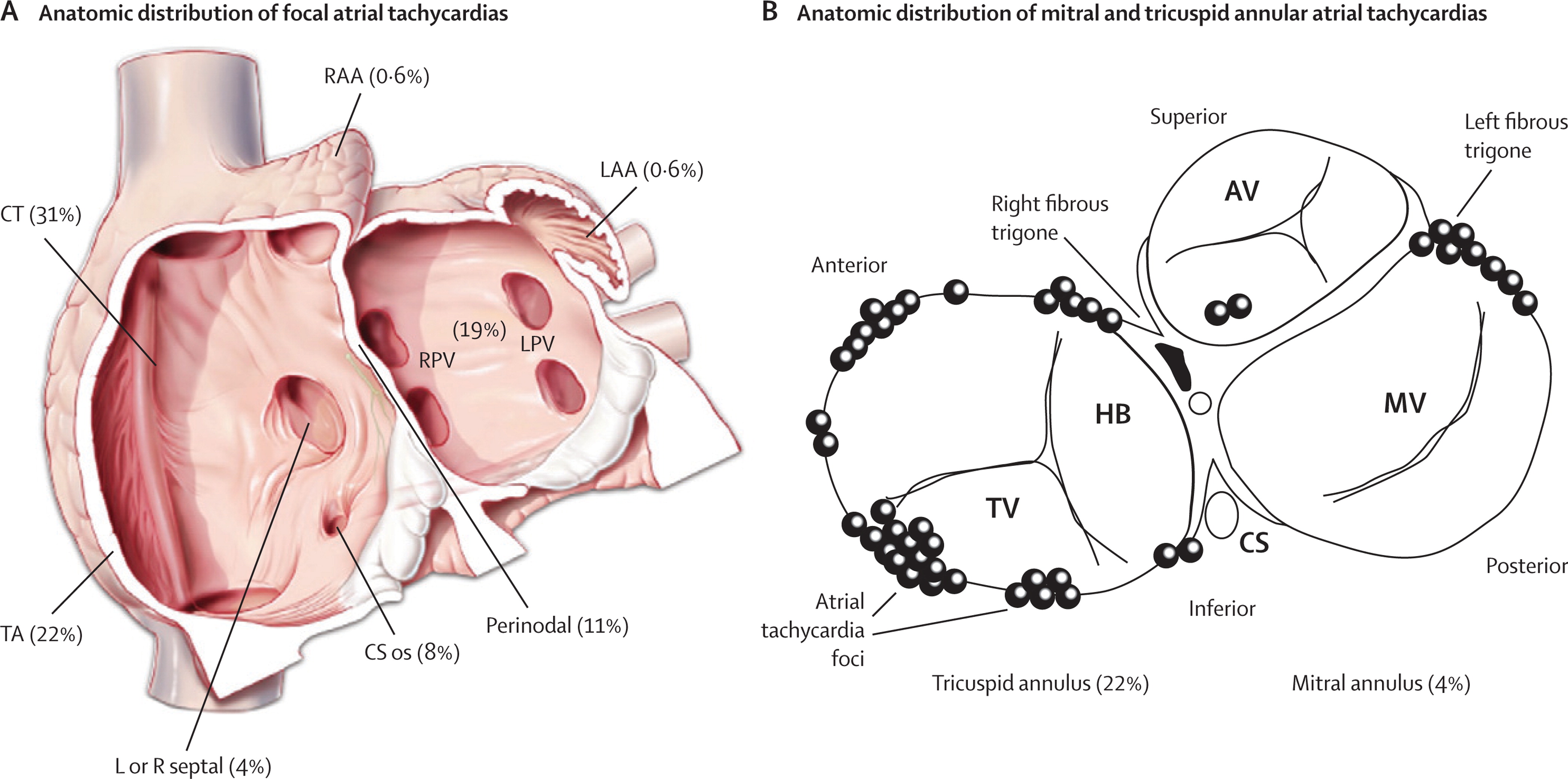 Ablation of AFL/AT Main Page